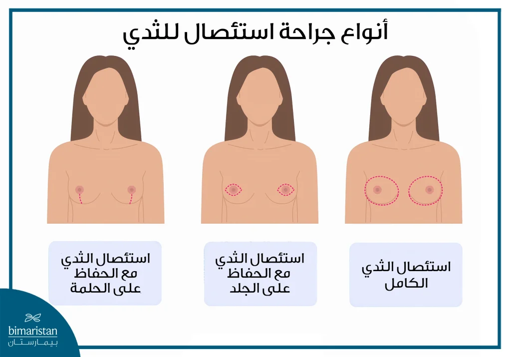 أنواع جراحة استئصال الثدي الكامل