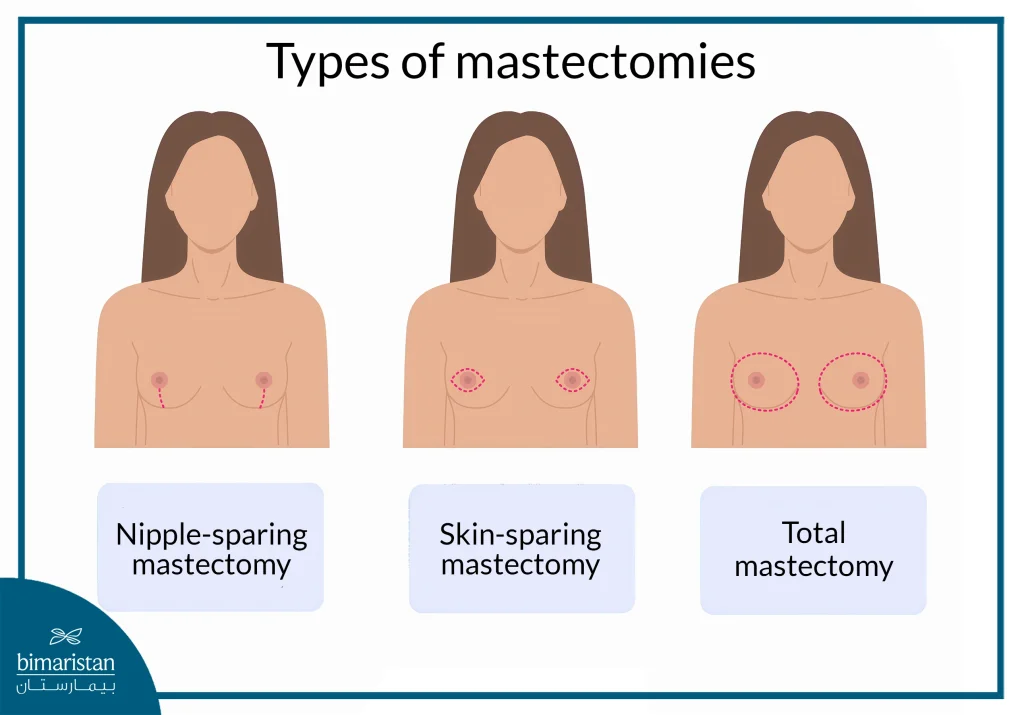 Types Of Total Mastectomy Surgery