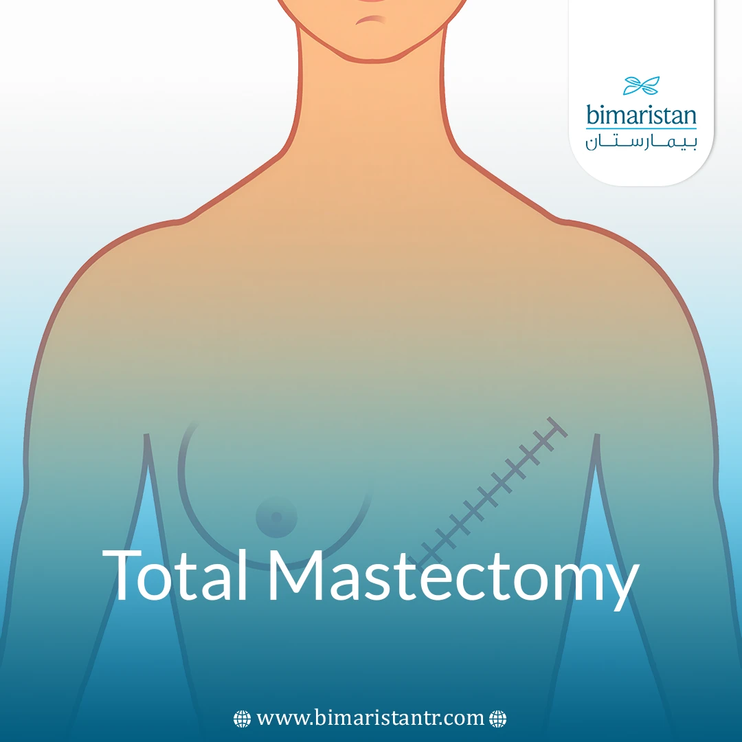 Total Mastectomy: Between Fear And Hope