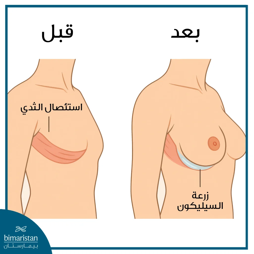 إعادة بناء الثدي بعد استئصال الثدي الكامل