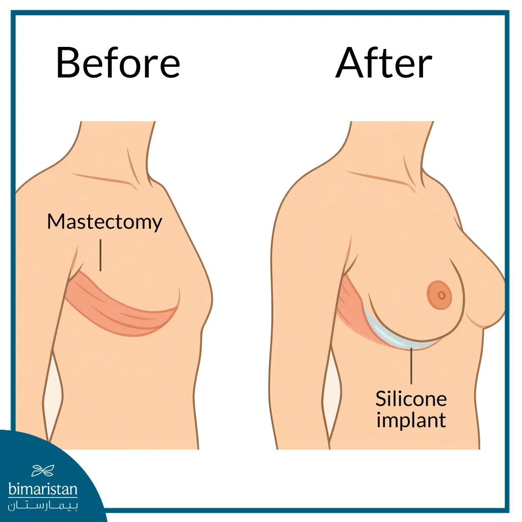 Breast Reconstruction After Total Mastectomy