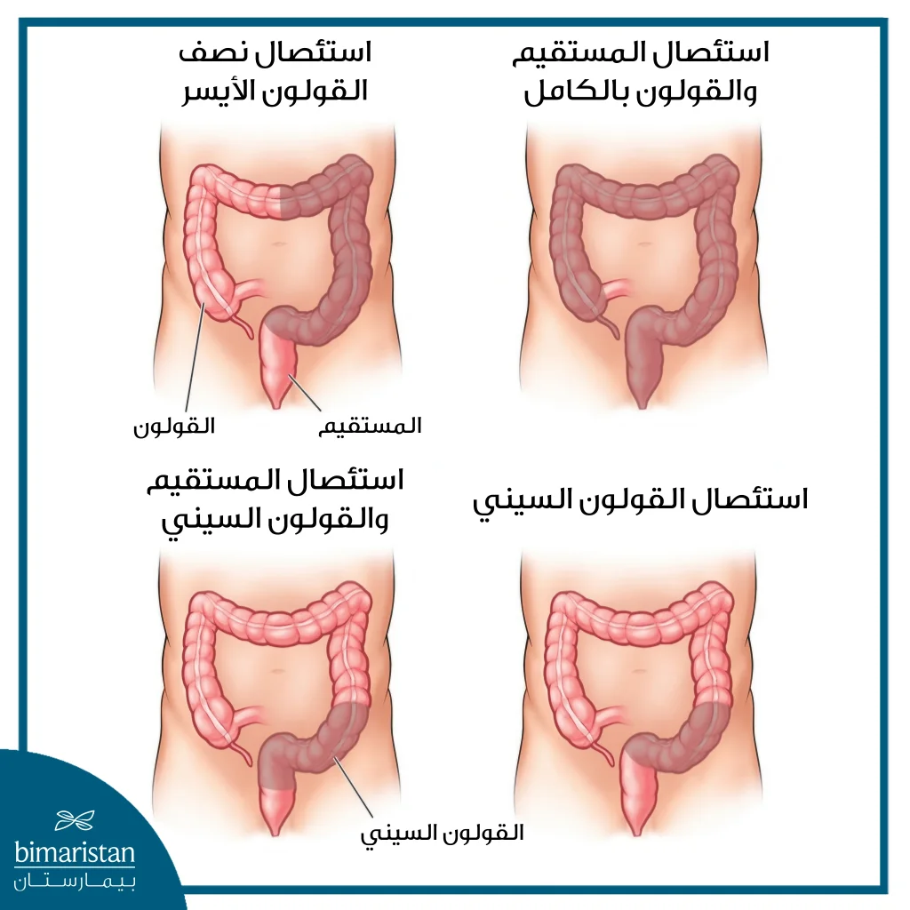 أنواع سرطان القولون