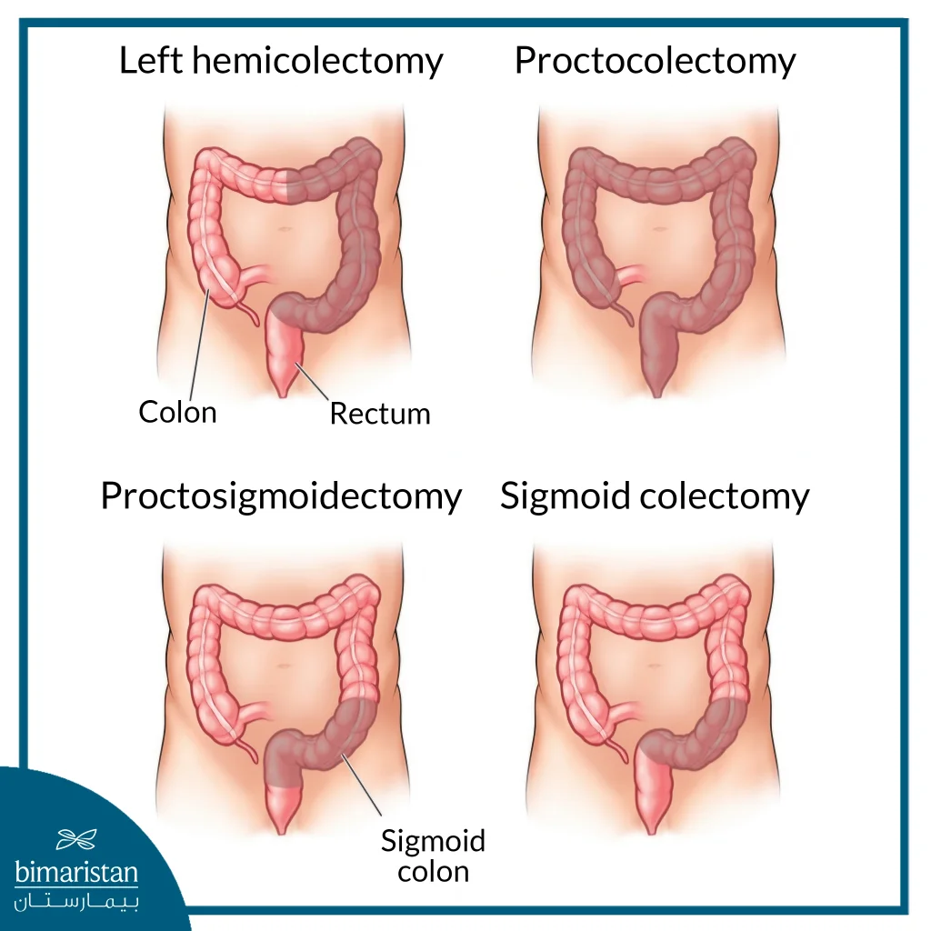 Types Of Colon Cancer Resection.
