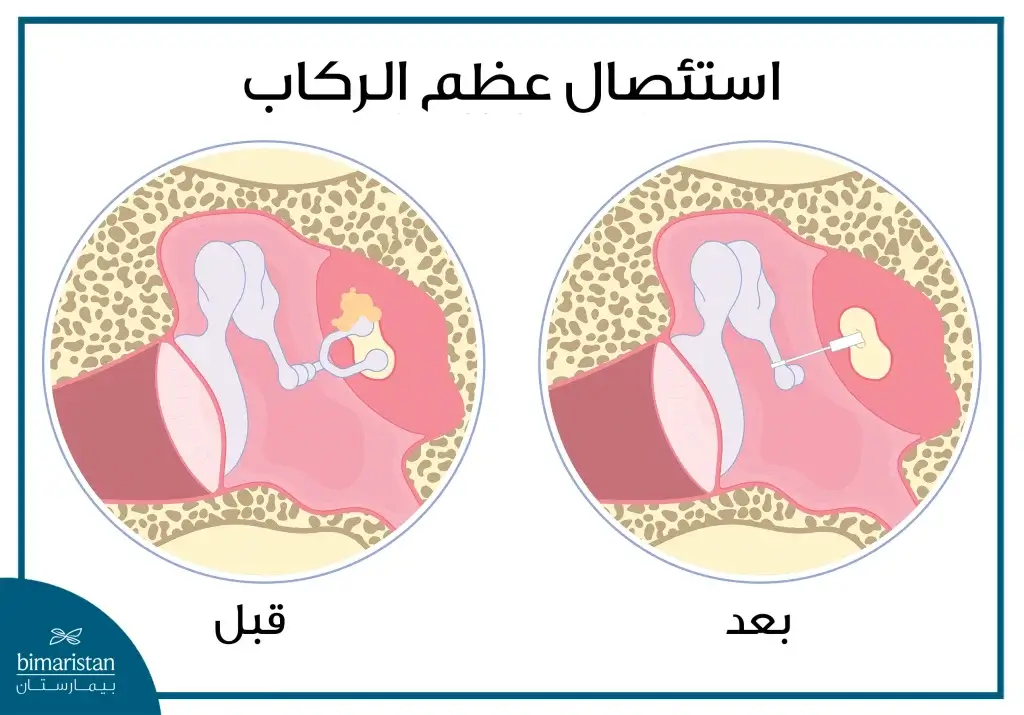 استئصال عظم الركاب: الحل الجراحي المتقدم لتحسين السمع في حالات تصلب الأذن 2 صورة توضح قيل وبعد استئصال عظم الركاب