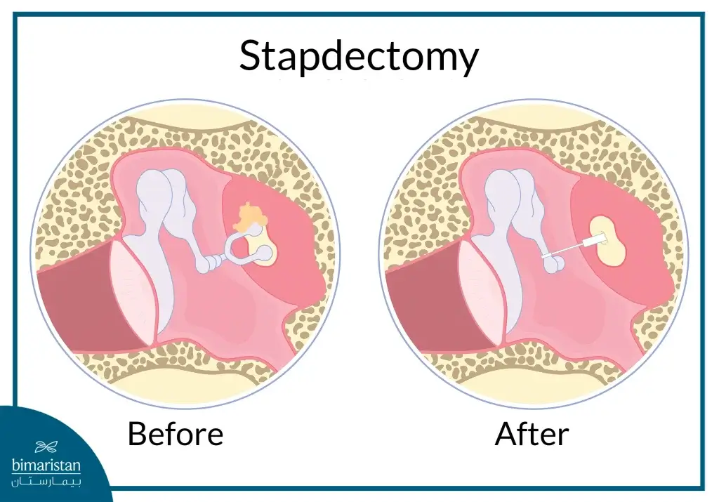 Before And After Stapedectomy