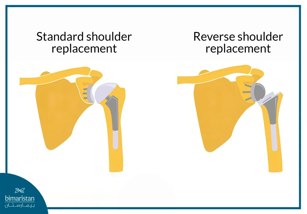 Difference Between Reverse Shoulder Arthroplasty And Standard Shoulder Replacement