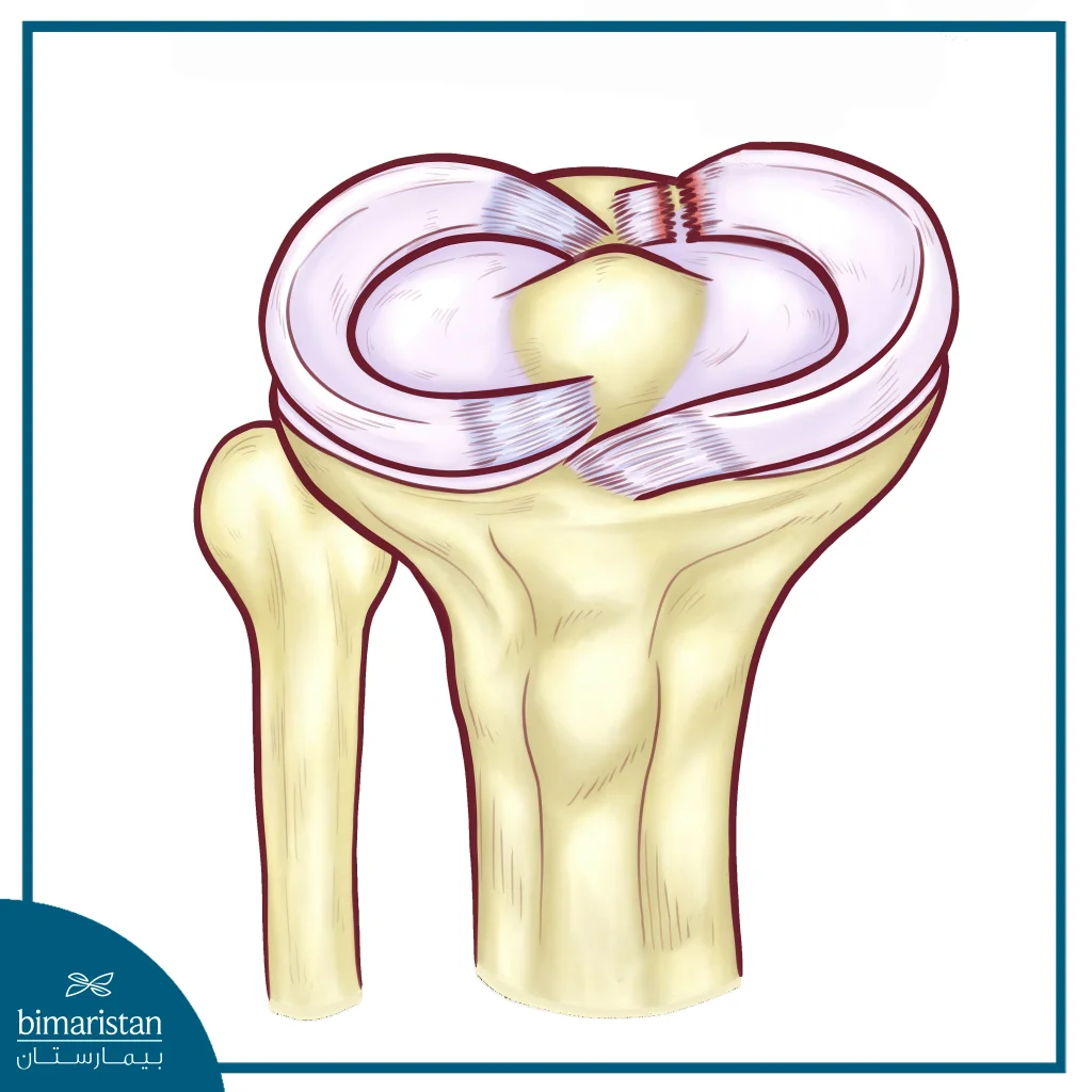 Knee Osteoarthritis Vs Meniscus Tear: Key Differences In Diagnosis And Treatment 5 Meniscus Tear