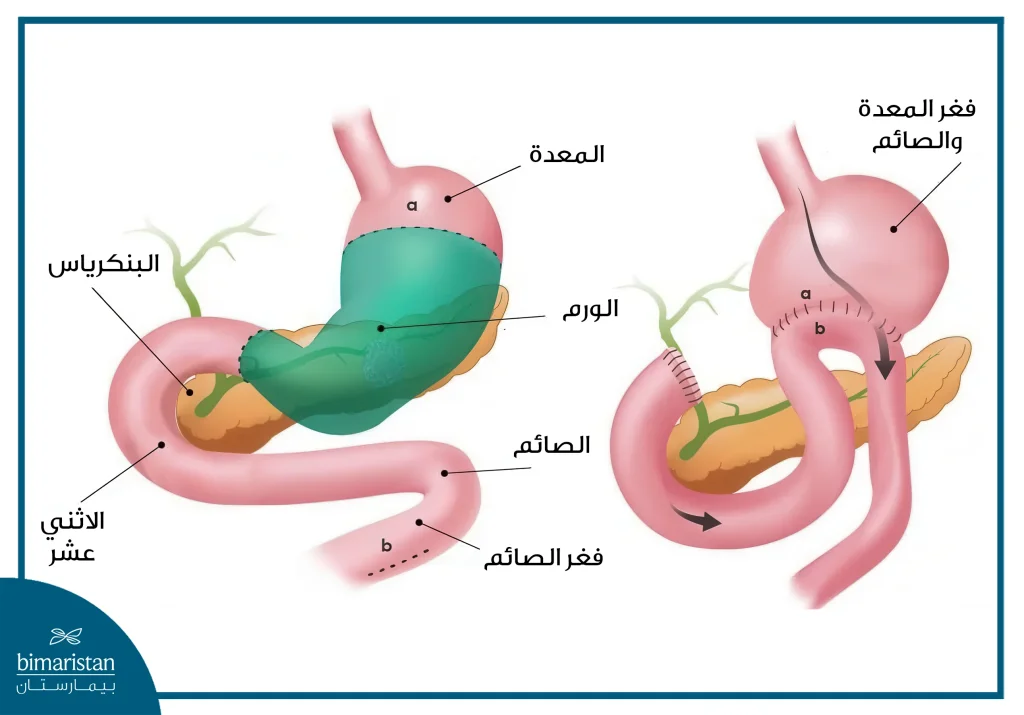 السبيل الهضمي بعد استئصال الورم المعدة
