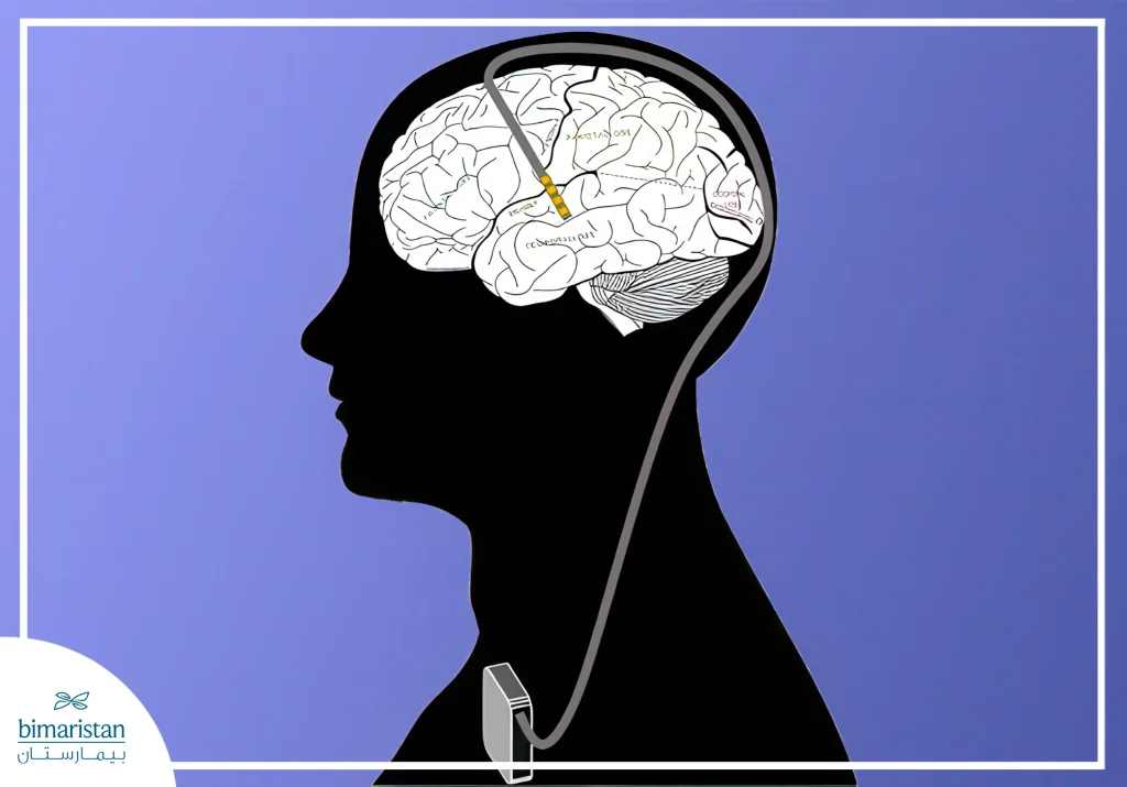 Deep Brain Stimulation Involves The Use Of An Implanted Device That Regulates Neural Signals