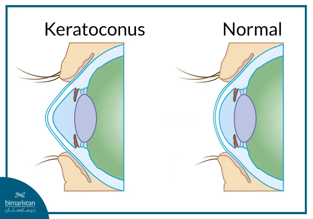 Comparison Of A Healthy Cornea And Corneal Cross-Linking Cost.