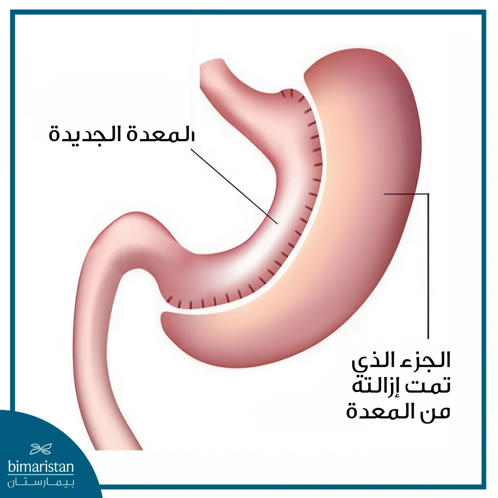 تكلفة تكميم المعدة بالمنظار في تركيا: دليل شامل شامل للأسعار والمميزات 2 شكل المعدة بعد عملية التكميم
