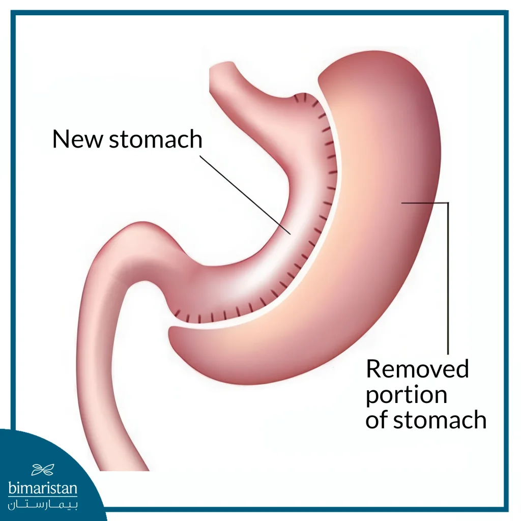 Stomach Shape After Laparoscopic Gastric Sleeve Cost In Turkey.