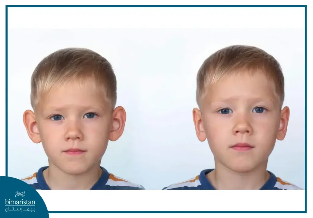 A Picture Showing The Difference In A Child'S Appearance Before And After Otoplasty, Highlighting The Results And Reflecting The Value Of Ear Surgery Cost In Turkey.