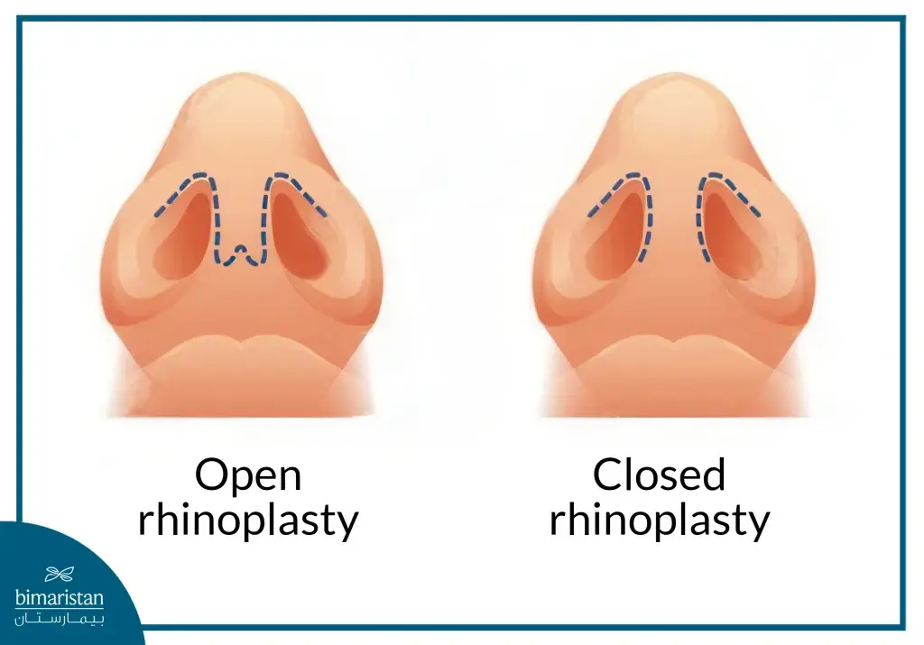 Rhinoplasty Cost In Turkey: What To Know Before Your Nose Surgery 2 Image Showing Closed And Open Nasal Surgery For Better Understanding Of Rhinoplasty Cost In Turkey.