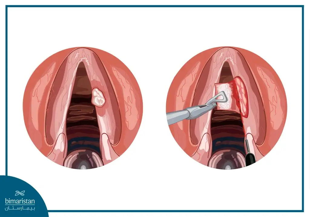 Laryngeal Surgery And Voice Are Illustrated In Pictures, Highlighting Procedures And Outcomes While Reflecting On The Laryngeal Surgery Cost In Turkey.
