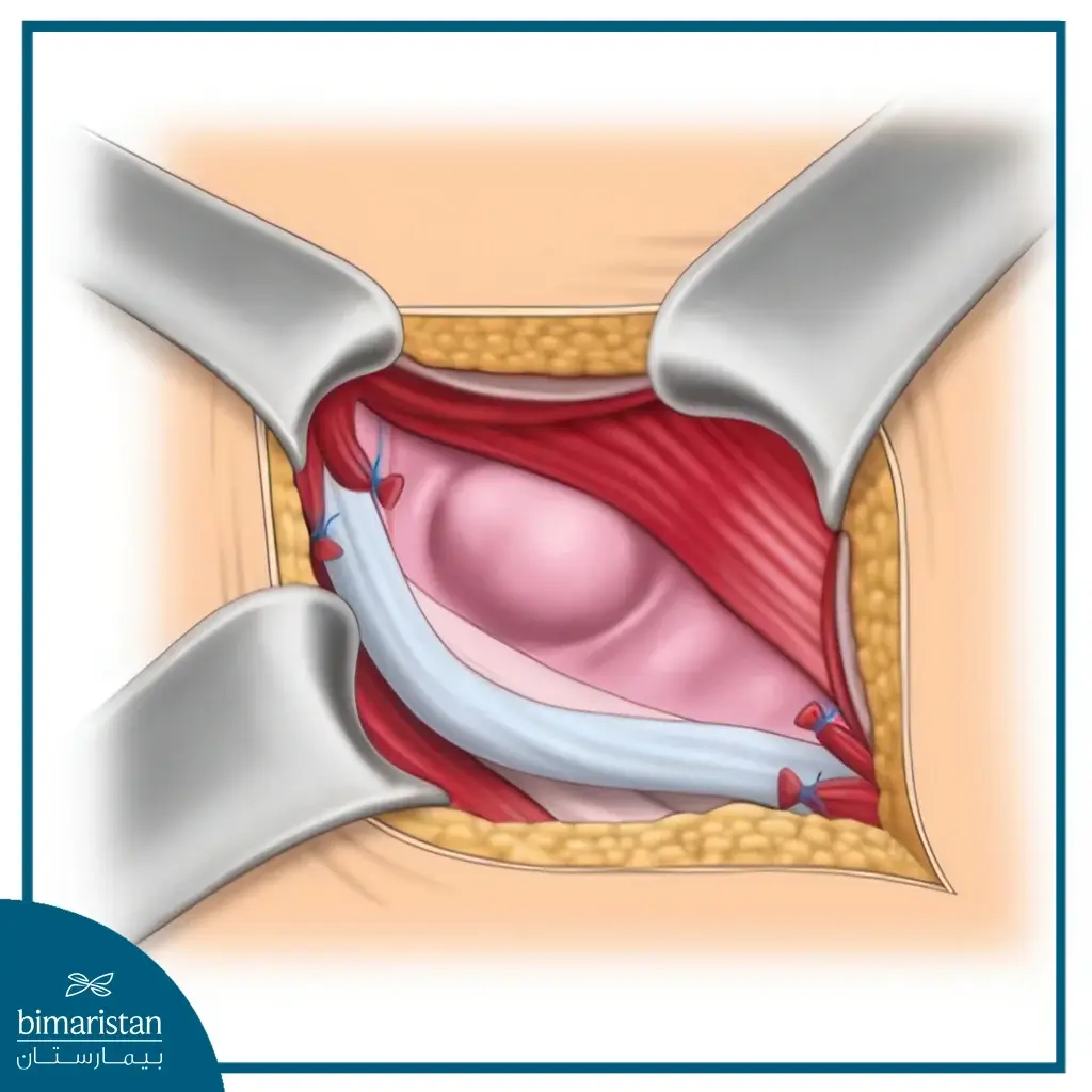 Inguinal Hernia Surgery Cost In Turkey: Full Guide &Amp; Key Tips 2 Discover Expert Care At A Fraction Of The Price—Inguinal Hernia Surgery Cost In Turkey Makes Quality Treatment Accessible And Affordable.