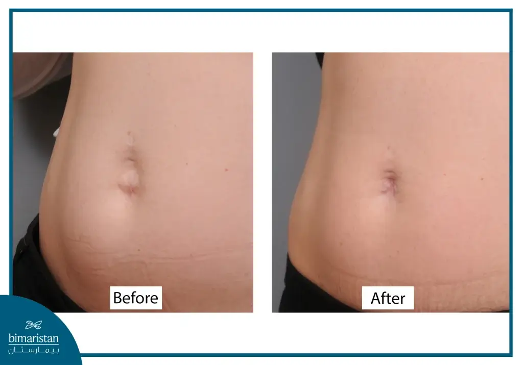 Umbilical Hernia Surgery Cost For Children In Turkey: A Complete Guide To Prices And Key Factors 2 Before And After Photo Showing Results And Outcomes Related To Umbilical Hernia Surgery Cost For Children In Turkey.