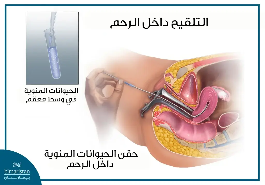 تكلفة علاج العقم في تركيا: الدليل الشامل 2 عملية التلقيح الإصطناعي (داخل الرحم Iui)