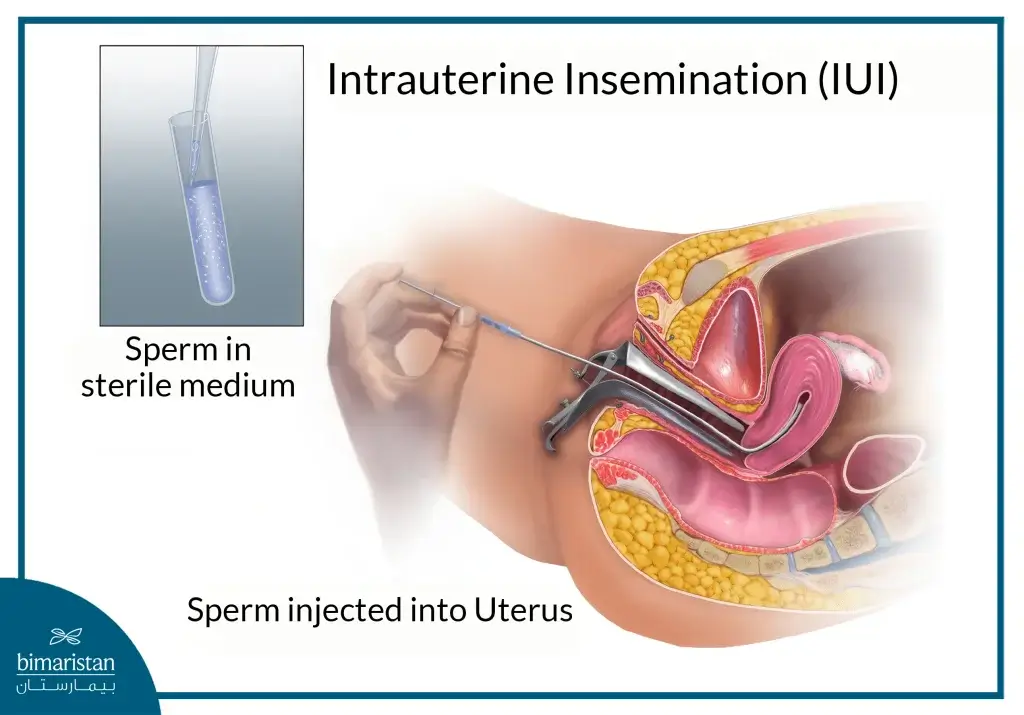 The Infertility Treatment Cost In Turkey: Comprehensive Guide 2 Intrauterine Insemination (Iui) Is A Common Fertility Procedure That Offers Promising Results With An Affordable Infertility Treatment Cost.