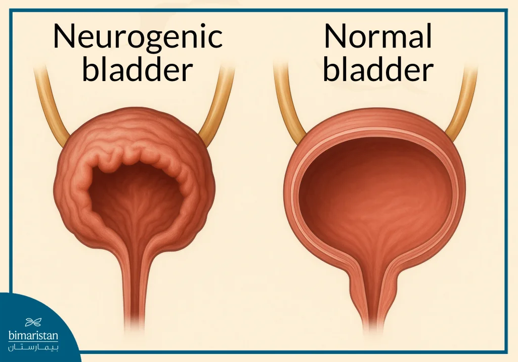 Neurogenic Bladder Treatment Cost In Turkey 2025: Latest Technologies And Prices 2 Image Showing The Difference Between A Neurogenic Bladder And A Normal Bladder With Neurogenic Bladder Treatment Cost In Turkey.