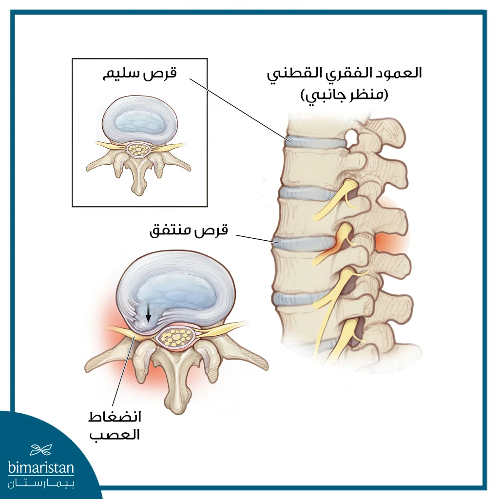 تكلفة عملية الديسك القطني في تركيا: جودة عالية وأسعار مناسبة 2 كيفية تولد الألم الناتج عن الديسك القطني