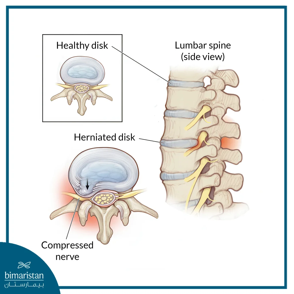 Lumbar Disc Surgery Cost In Turkey: High Quality And Affordable Prices 2 Image Showing How Lumbar Disc Surgery Cost In Turkey Pain Occurs.