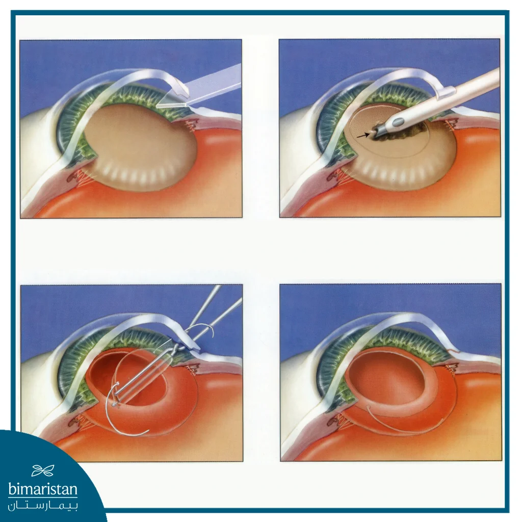 Cataract Surgery Cost In Turkey: Quality At Affordable Prices 2 Image Showing The Cataract Surgery Cost In Turkey Steps.