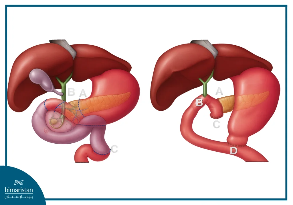 Pancreatic Bypass Surgery Cost In Turkey: Guaranteed Results At An Affordable Price 2 Image Showing The Pancreatic Bypass Surgery Cost In Turkey Pathway After The Bypass Procedure.