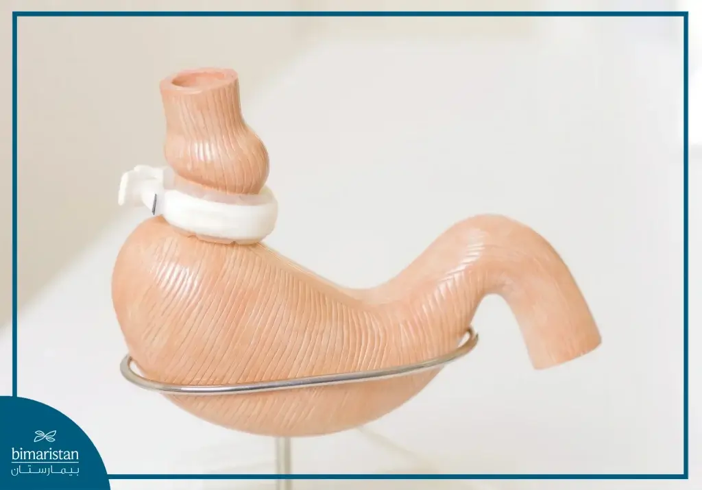 Gastric Banding Cost In Turkey: Complete 2025 Price Breakdown 2 An Image Showing How Gastric Banding Surgery Is Done