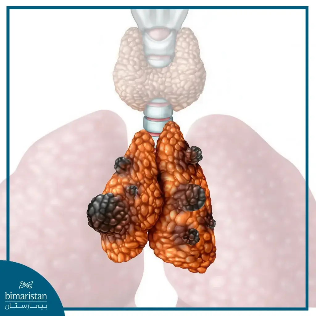 Image Showing A Thymus Tumor Treated With Laparoscopic Mediastinal Tumor Surgery.
