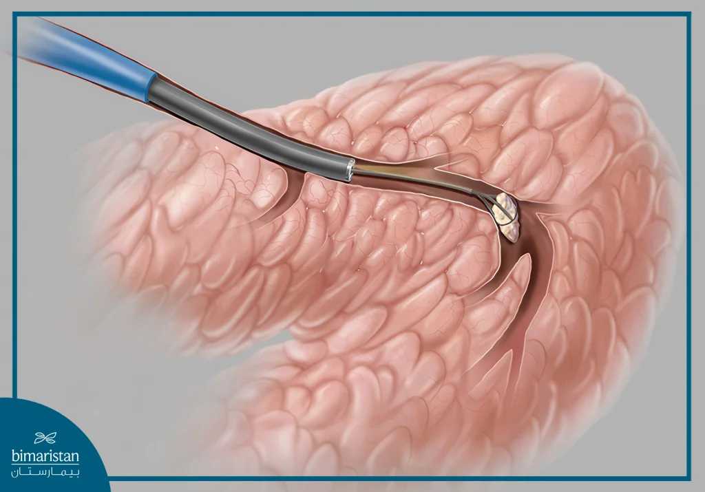 جراحة الغدد اللعابية بالمنظار