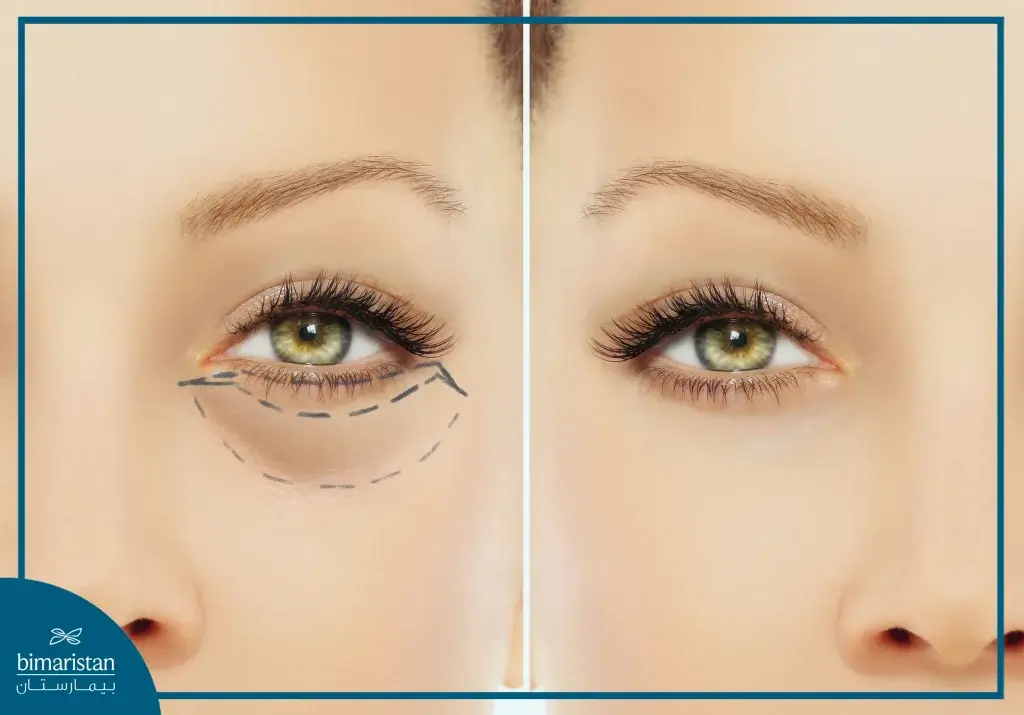 صورة توضح شكل العين قبل وبعد عملية رأب الجفن (Blepharoplasty)