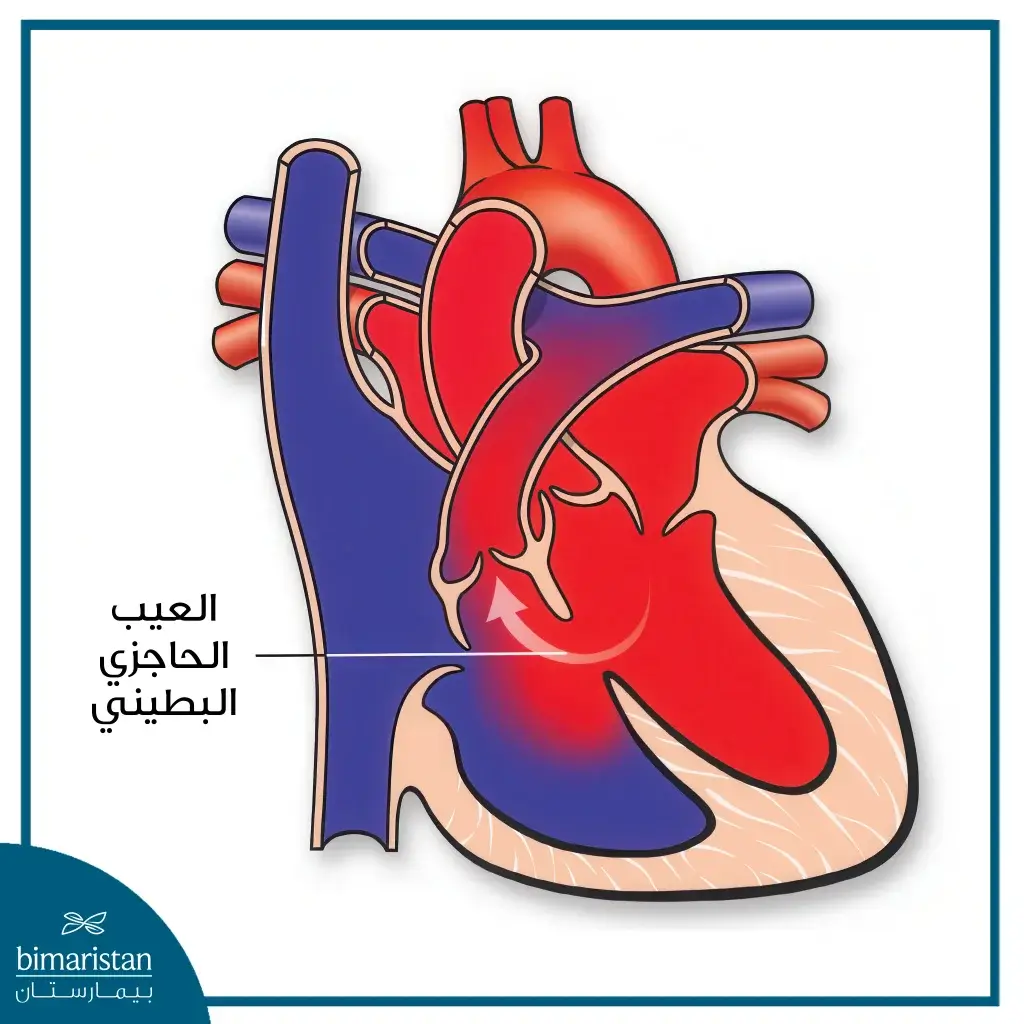 جراحة قلب الأطفال: تقنيات حديثة ونسب نجاح مرتفعة لضمان حياة صحية لطفلك 4 العيب الحاجزي البطيني (Vsd)