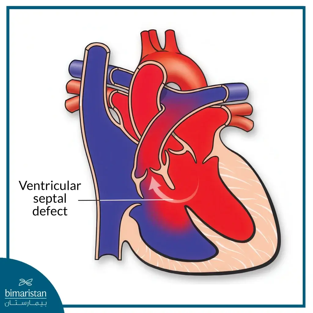 Pediatric Heart Surgery: Modern Techniques And High Success Rates For A Healthy Child 4 Ventricular Septal Defect (Vsd)