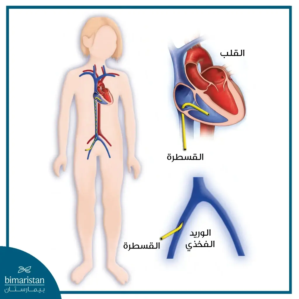 جراحة قلب الأطفال: تقنيات حديثة ونسب نجاح مرتفعة لضمان حياة صحية لطفلك 3 استخدام القسطرة في جراحة قلب الأطفال