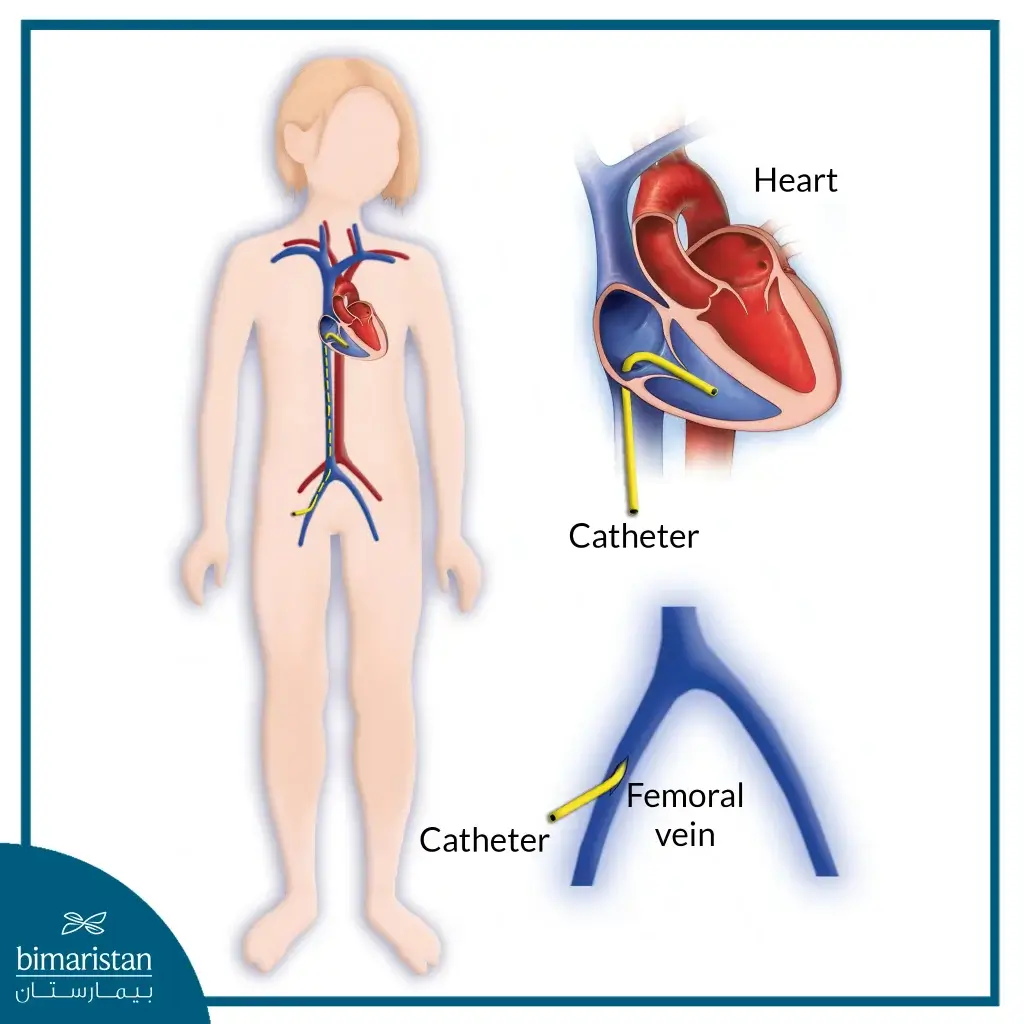 Pediatric Heart Surgery: Modern Techniques And High Success Rates For A Healthy Child 3 Catheterization In Pediatric Heart Surgery
