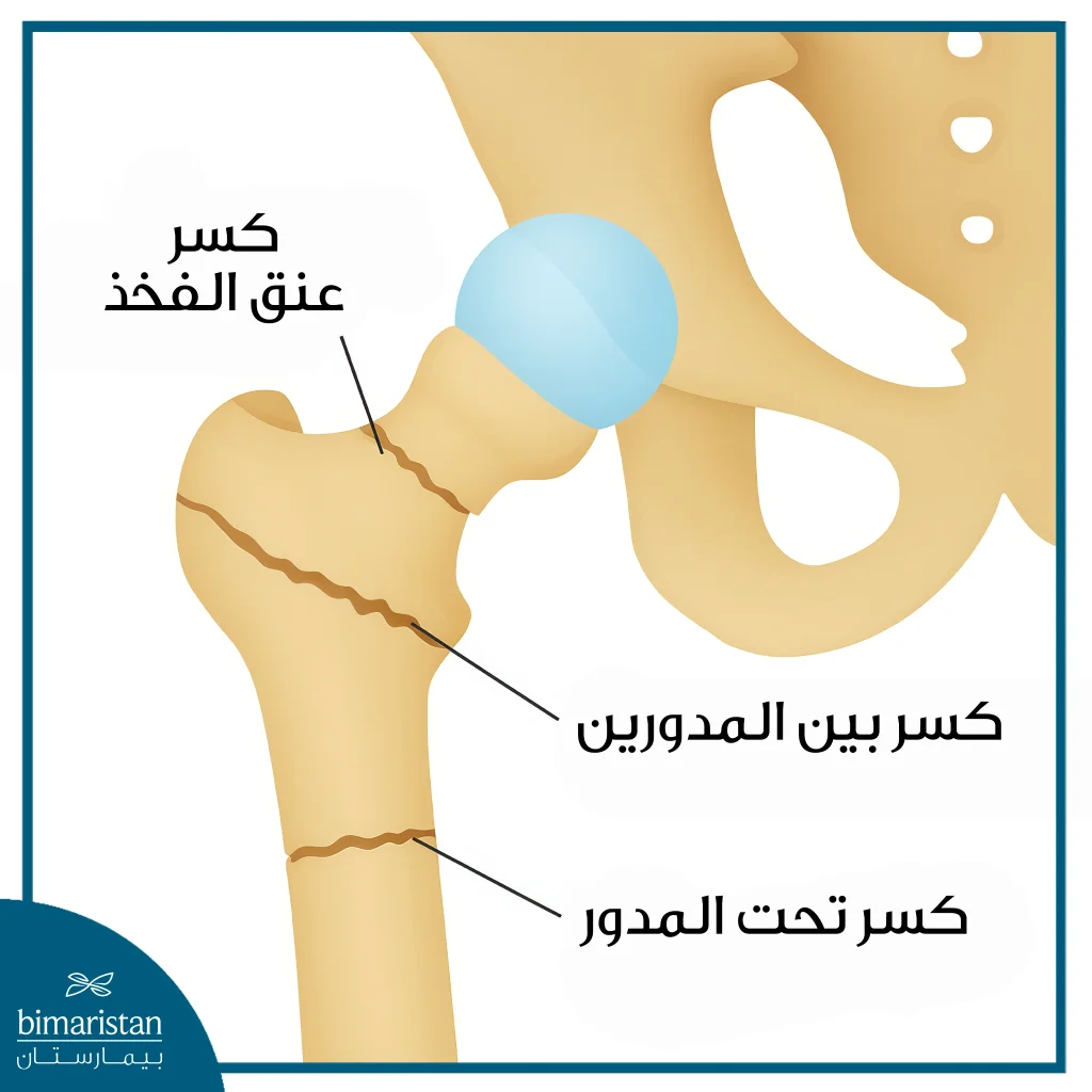 جراحة كسر الفخذ عند كبار السن: أنواع كسور الفخذ