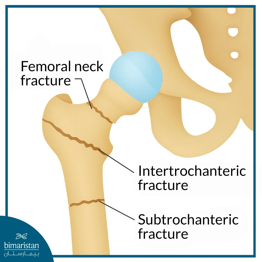 Femoral Fracture Surgery In The Elderly: Indications, Recovery Rates, And What To Expect 4 Femoral Fracture Surgery In The Elderly: Types Of Femoral Fractures