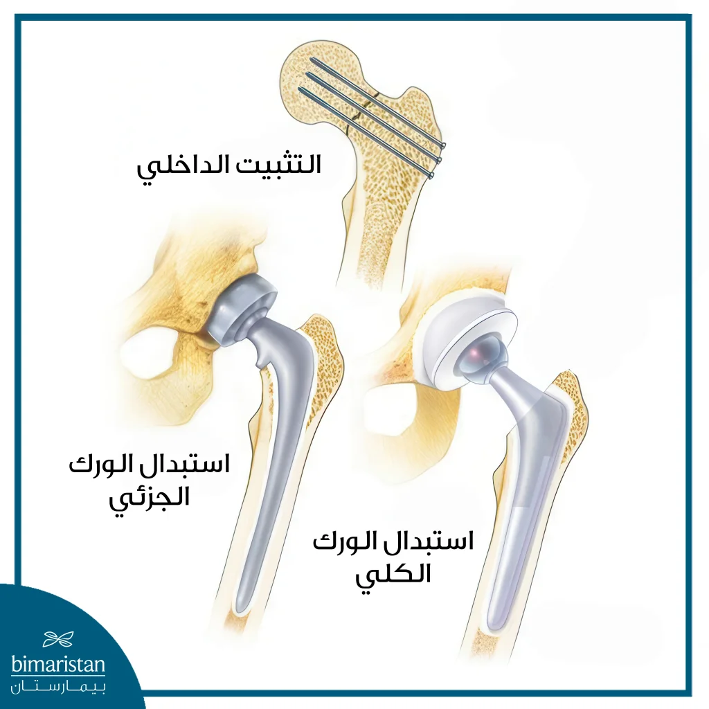 أنواع جراحة كسر الفخذ عند كبار السن