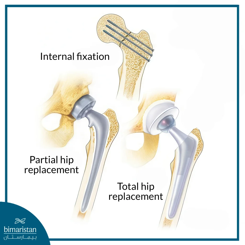 Femoral Fracture Surgery In The Elderly: Indications, Recovery Rates, And What To Expect 5 Types Of Femoral Fracture Surgery In The Elderly