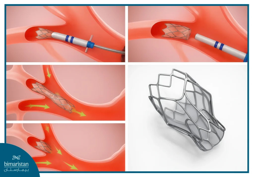 Copd Treatment: Effective Steps For Easy Breathing 3 Steps For Installing An Endobronchial Air Valve To Treat Emphysema And Improve Breathing