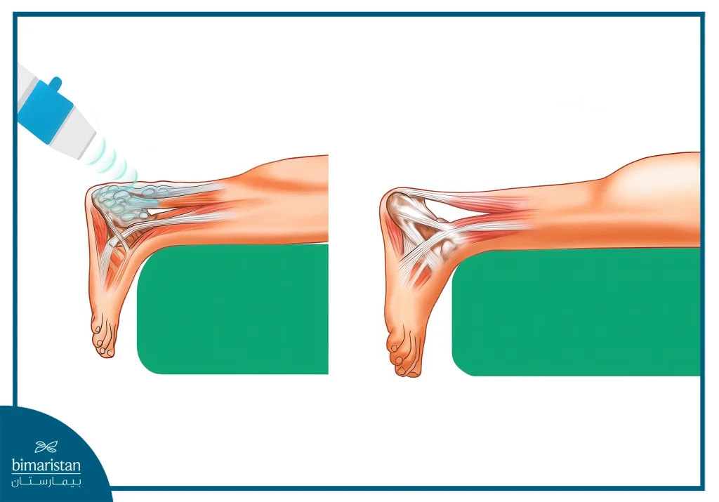 How Shockwave Therapy For Tendonitis Is Performed