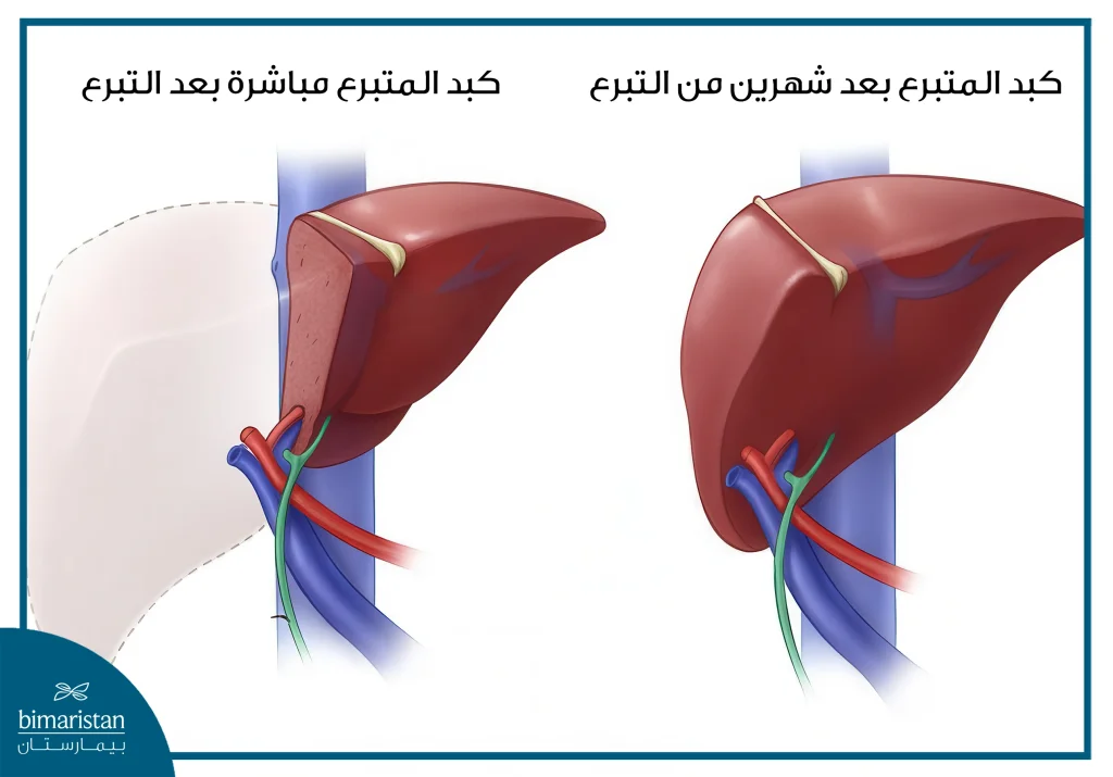 صورة توضح نمو الكبد عند الشخص المتبرع ومما يشجع على التبرع