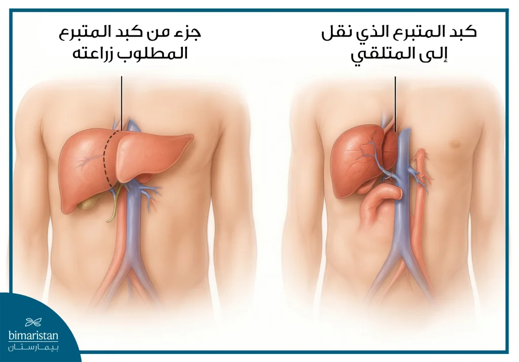 صورة توضح بشكل مبسط عملية زراعة الكبد ونقلها من الشخص المتبرع