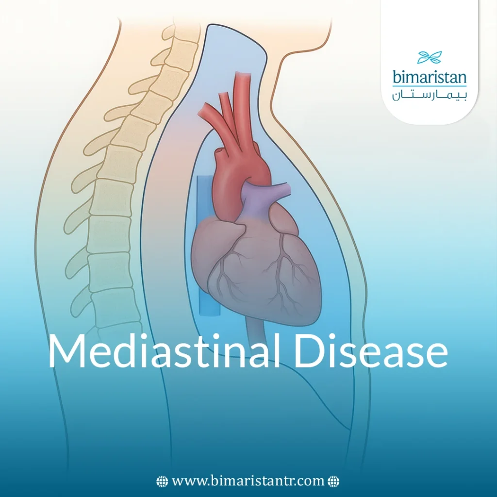 Mediastinal Diseases: Causes, Types, Diagnosis And Treatment