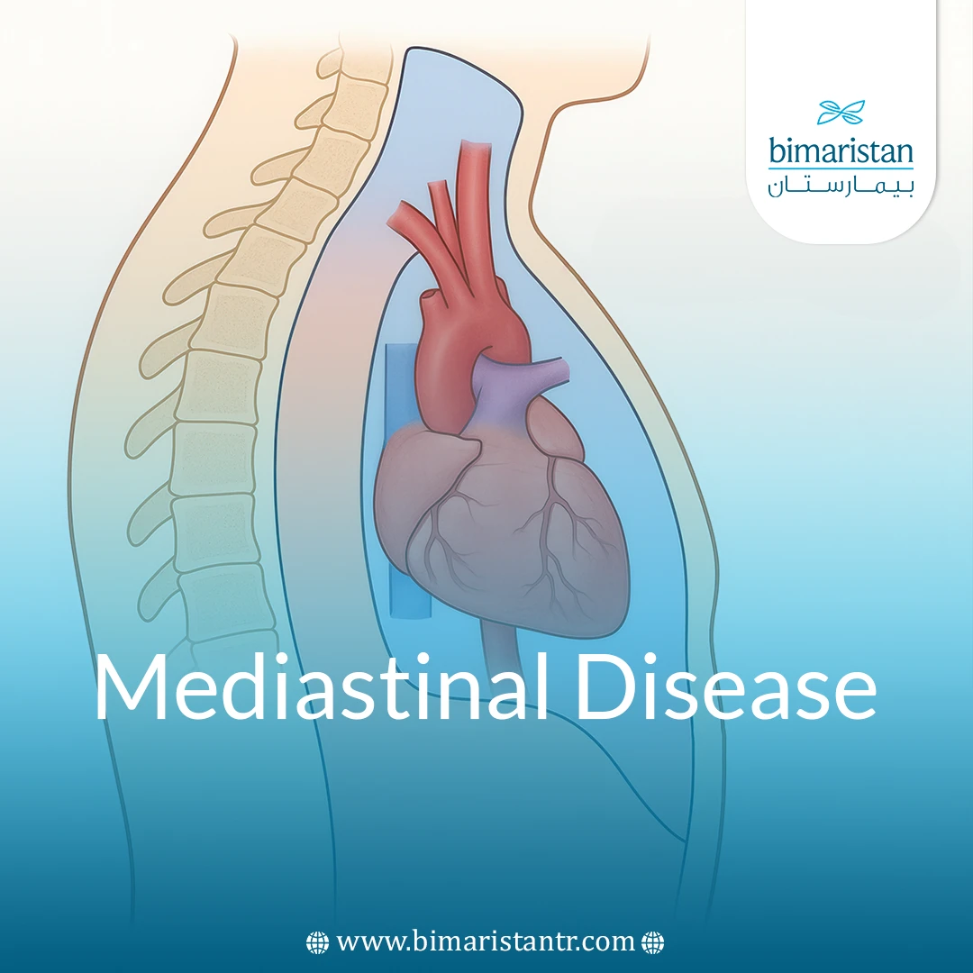 Mediastinal Diseases: Causes, Types, Diagnosis And Treatment