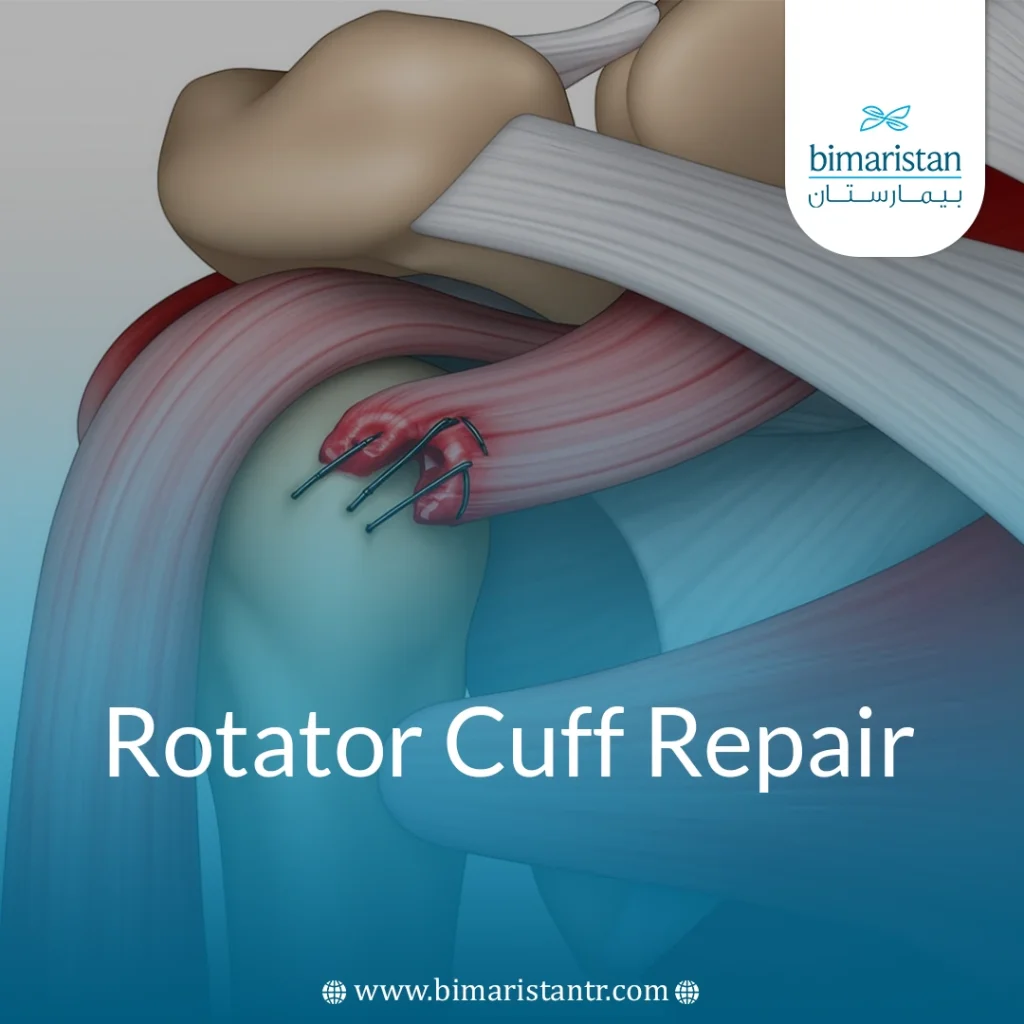 Rotator Cuff Repair: Shoulder Recovery After Tendon Rupture