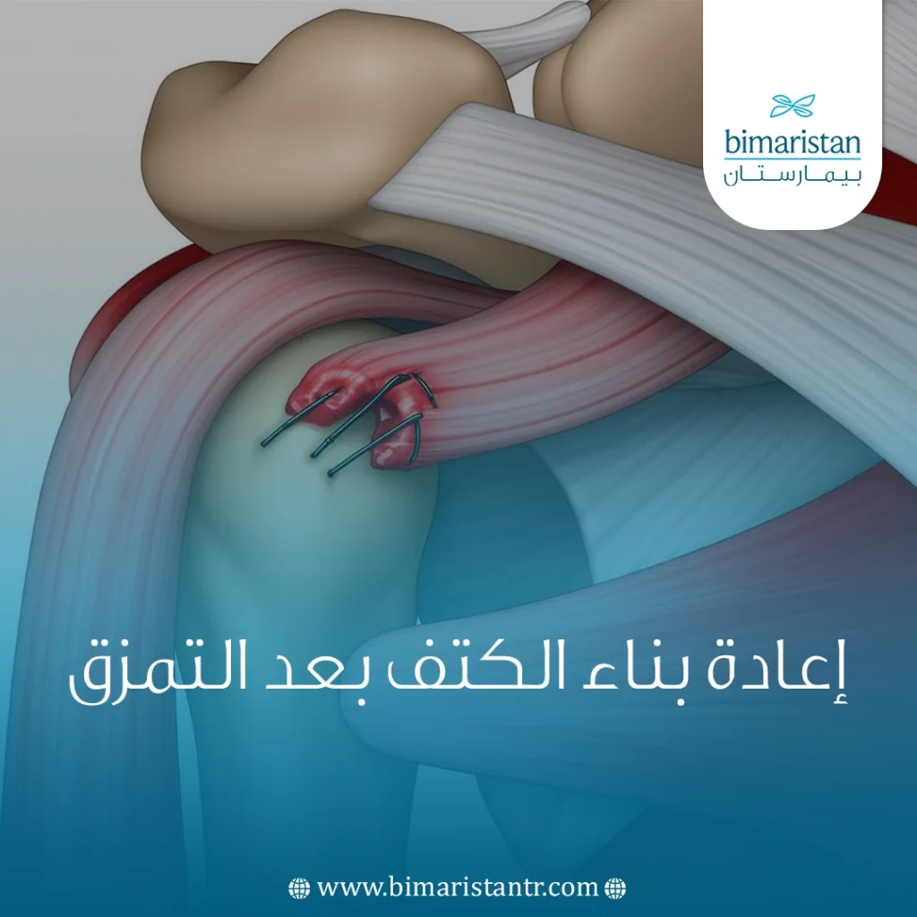 إعادة بناء الكتف بعد التمزق