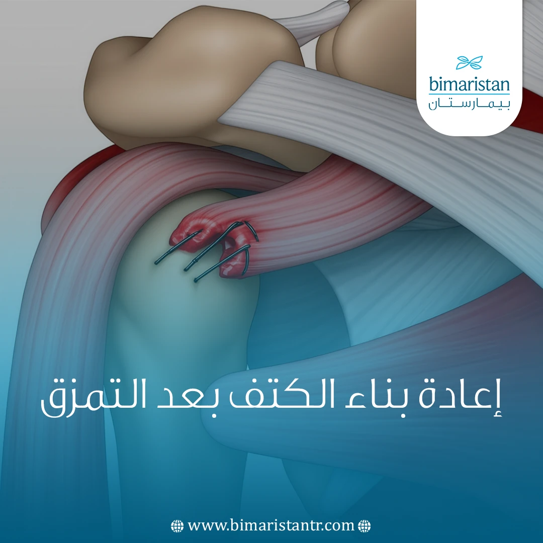 إعادة بناء الكتف بعد التمزق