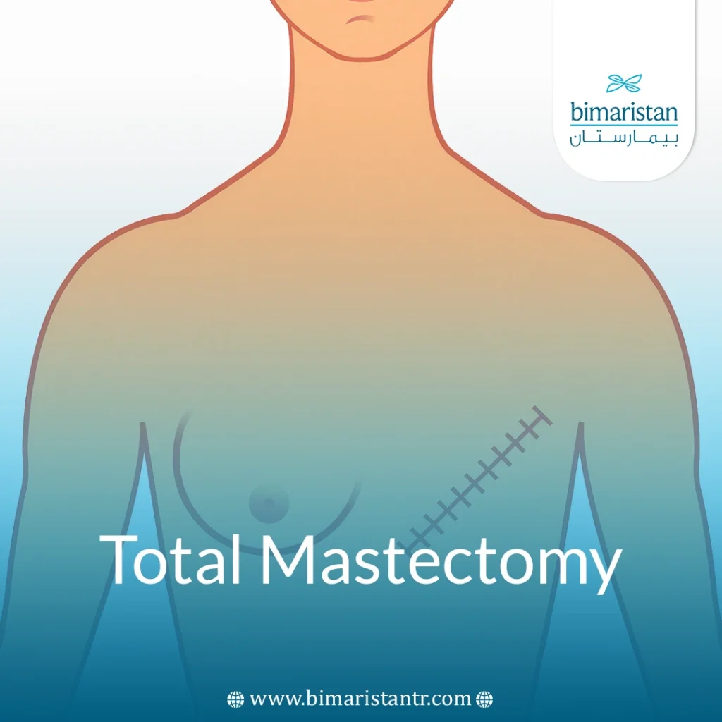 Total Mastectomy: Between Fear And Hope